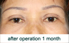 plastic-surgery-blepharoplasty